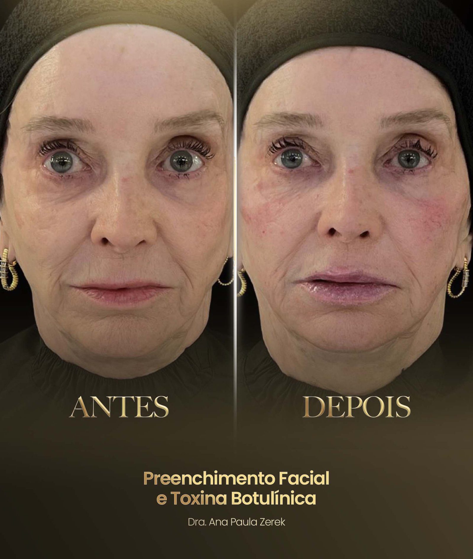 antesdps-ana1