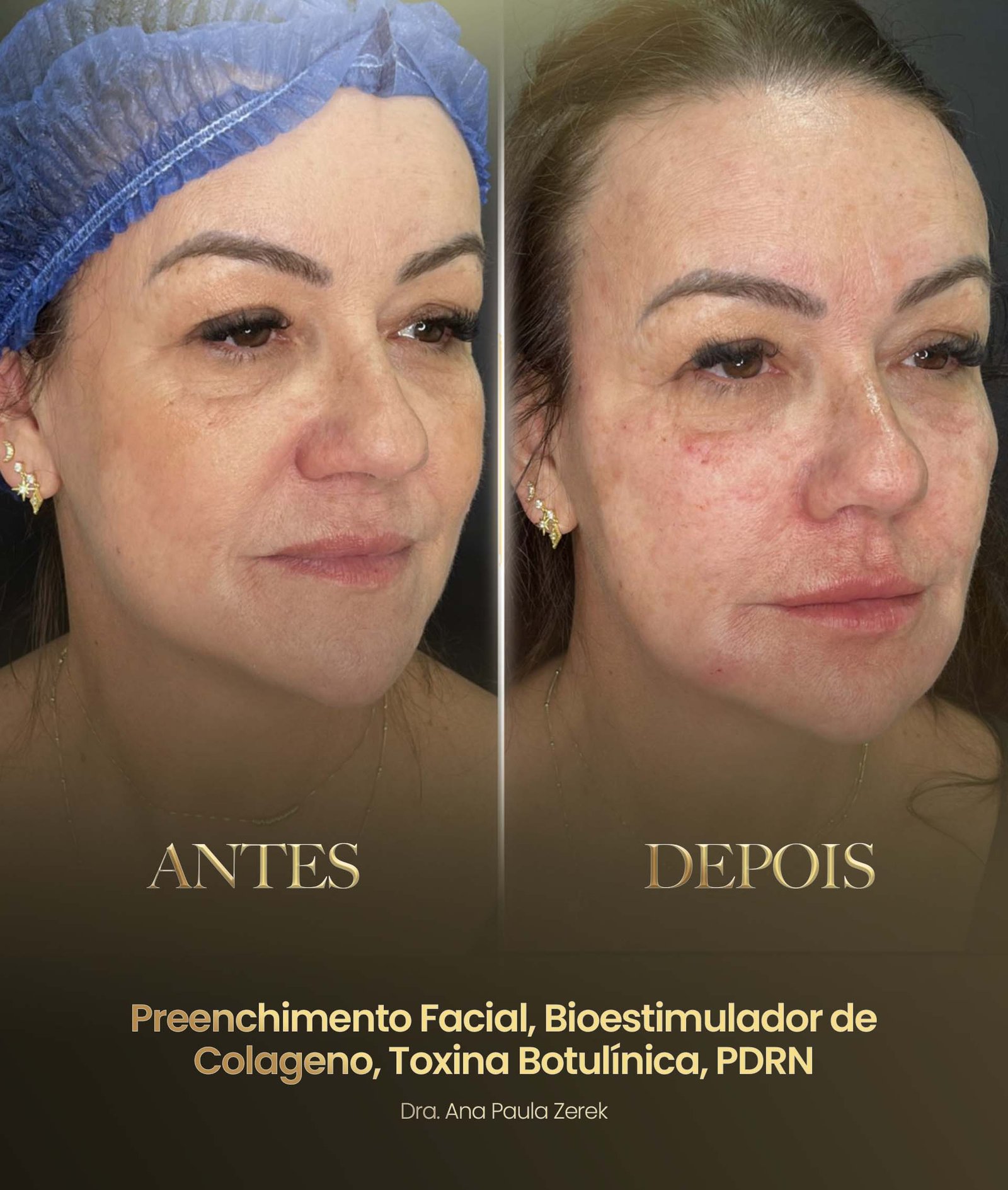 antesdps-ana2